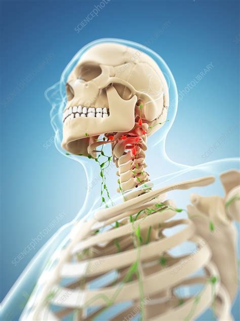 inflamed lymph nodes artwork stock image  science photo