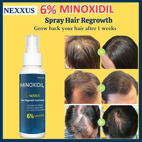 Top more than 149 hair growth spray minoxidil super hot - ceg.edu.vn