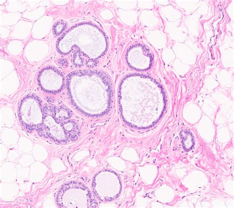 Pathology Outlines Microcysts