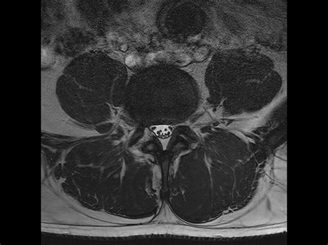 Lumbar Spine Bulging Disc Compressed Sense Philips Mr Body Map
