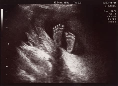 Ultrasound of In Uterus Baby at 22 weeks. Healthy baby in belly ...