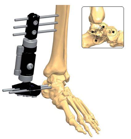 Ankle Fusion Recovery Orthofix Abs