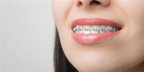 Orthodontic Treatment Duration Dr Jamilian