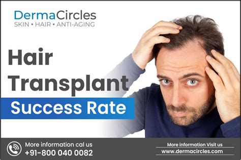 Hair Transplant Success Rate Blog Dermacircles