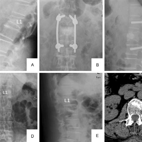 Sagittal T1 Weighted Enhanced Mri Discitis T10 T11 T12 And