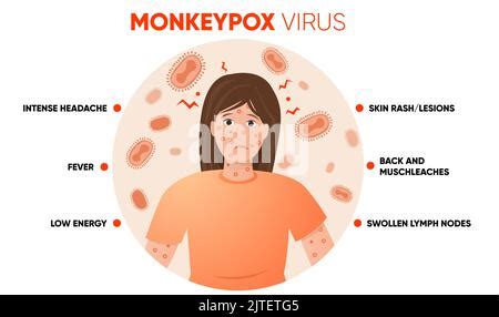 Monkeypox Virus Symptome Einfache Infografik Poster F R Social Media