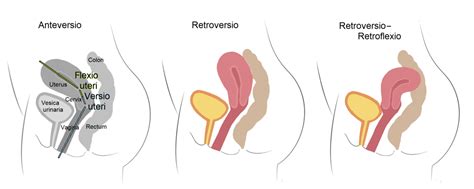 File:Retroverted and Retroflexed Uterus 1.png - Wikimedia Commons