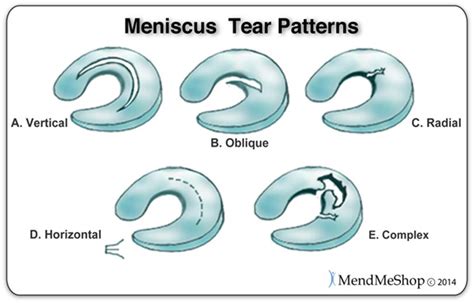 Meniscus Tear Wiki