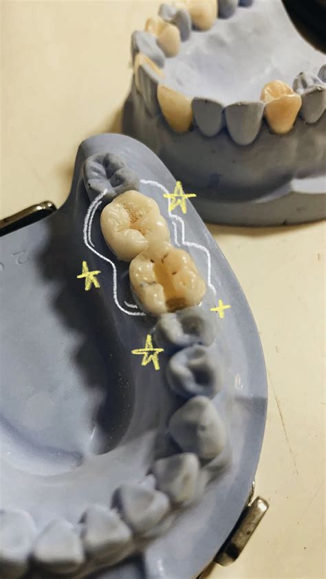 Blok Dental Caries 1 Yg Menyusahkan Tapi Menyenangkan En 2022