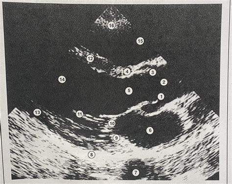 Parasternal Long Axis View Diagram | Quizlet