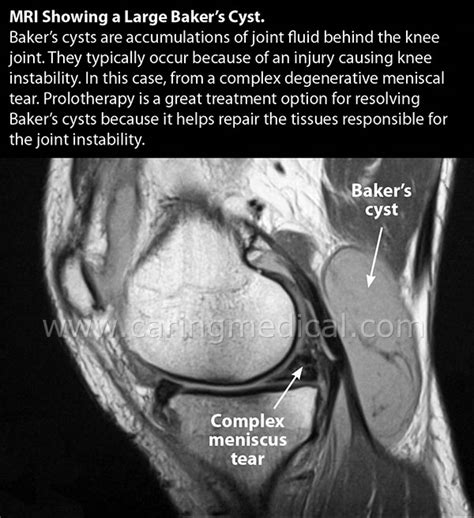 Baker S Cyst Drainage Cpt Code - Best Drain Photos Primagem.Org