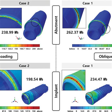 Stress Distribution On Abutment And Implant Download Scientific Diagram