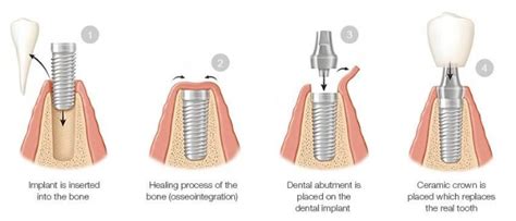 ILAJAK Medical Learn About The Dental Implant Procedure And Its Pros