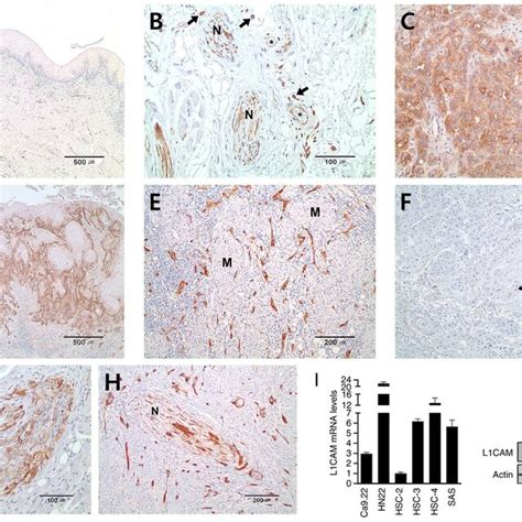 L Cam Expression In Oral Tongue Squamous Cell Carcinoma Tissues And