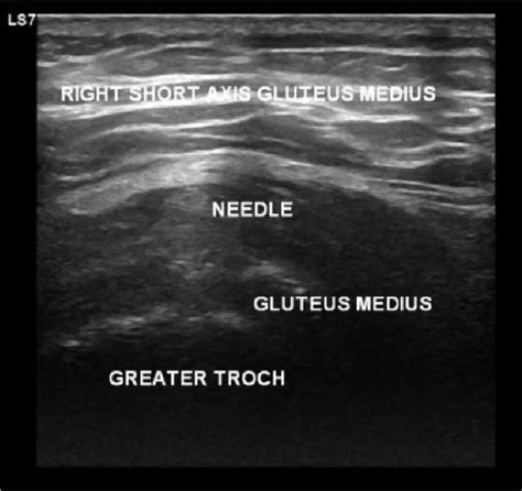 Ultrasound Guided Platelet Rich Plasma Injection Into The Gluteus