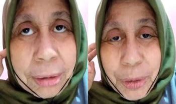 Goriau Idap Penyakit Langka Wanita Tahun Ini Lebih Tua Dari Usianya