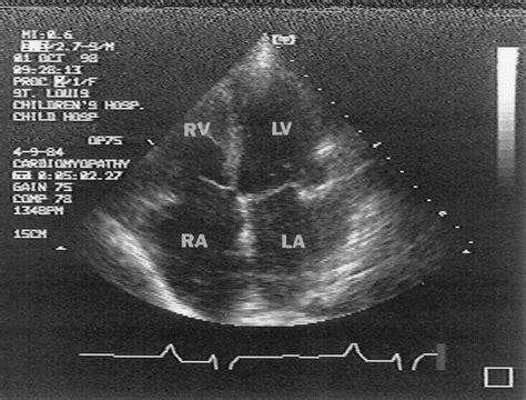 Cardiac Transplantation For Pediatric Restrictive Cardiomyopathy