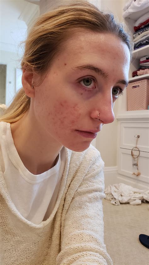 Accutane Before And After Cystic Acne