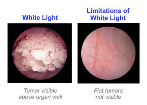 Bladder Cancer: Blue light cystoscopy - Imagin Medical