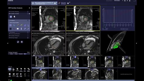 Syngo Via For Mri