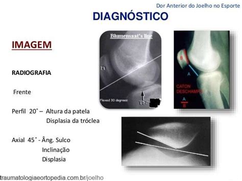 S Ndrome Femoropatelar Traumatologia E Ortopedia