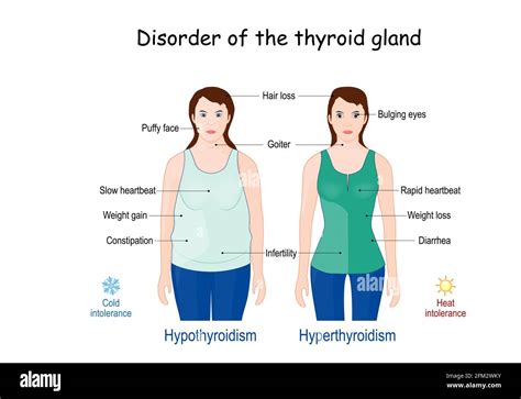 Enlarged thyroid gland hi-res stock photography and images - Alamy