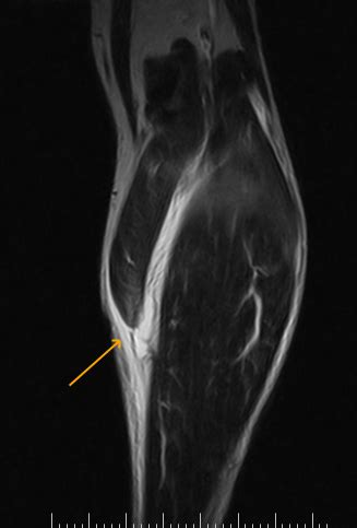 Tennis Leg Mri Sumer S Radiology Blog