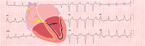 Alteraciones En El Electrocardiograma