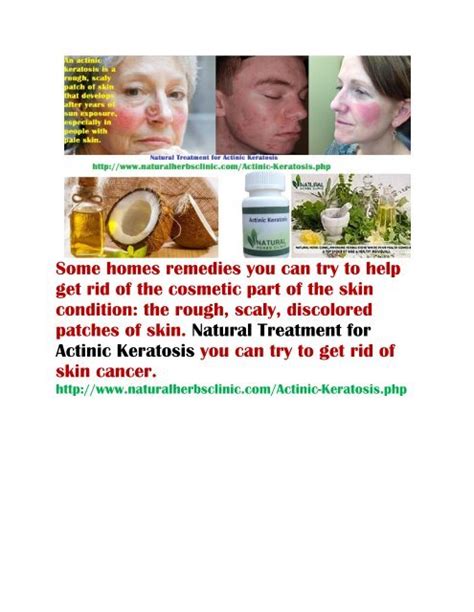 Actinic Keratosis Natural Treatment