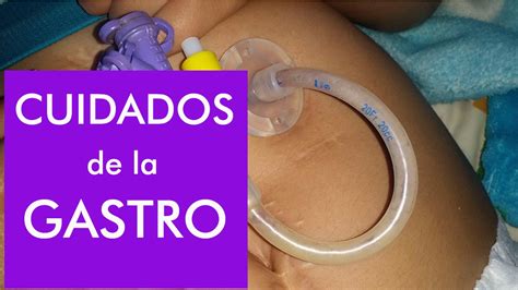 Gastrostomía Lavado de sonda y como evitar taponamientos YouTube