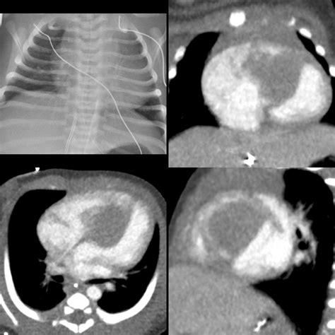 Pediatric Cardiac Rhabdomyoma Pediatric Radiology Reference Article