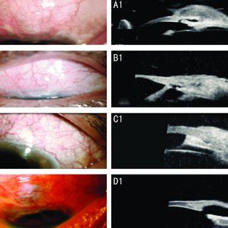 PDF Functional Evaluation Of The Filtering Bleb By Ultrasound