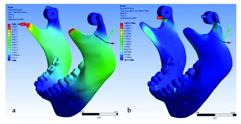 Mandible Deformation A And Von Mises Jaw Stress B Caused By A