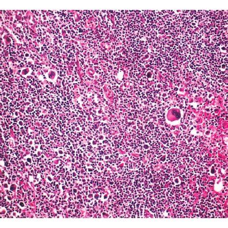 Inguinal Lymph Node Examination Shows Mixed Cellular Type Hd With