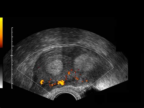 Icono 21 Echographie des malformations utérines