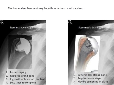 New Technology In Total Shoulder Arthroplasty Boston Shoulder Institute