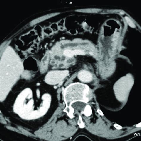 Abdominal Computed Tomography Showed Non Homogeneous Cystic Mass In The