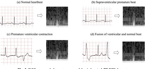 Ecg Heartbeat Classification Using Deep Transfer Learning With