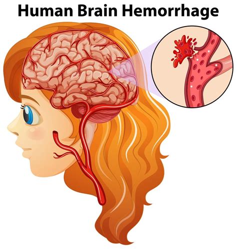 Diagram Showing Human Brain Hemorrhage 434335 Vector Art At Vecteezy