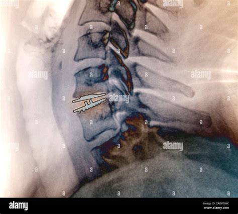 Disco Intervertebral Cervical Implante Color De Rayos X Lateral De La