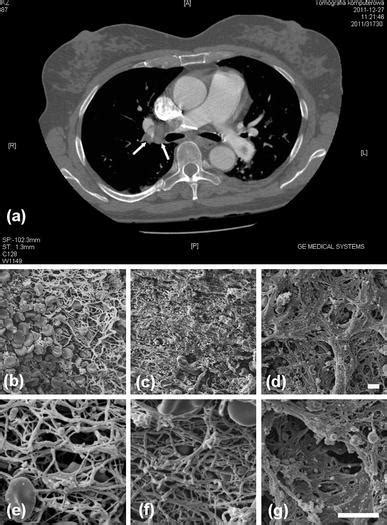 Computed Tomography And Scanning Electron Microscopic Sem Images