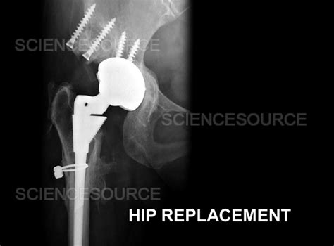 Hip Replacement, X-Ray | Stock Image - Science Source Images