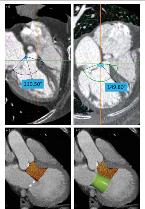 Figure 3 From Role Of Computed Tomography In Transcatheter Replacement