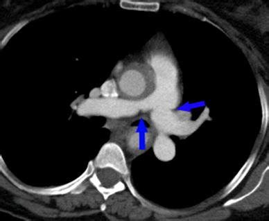 There is bilateral pulmonary artery stenosis (arrows) which can be ...