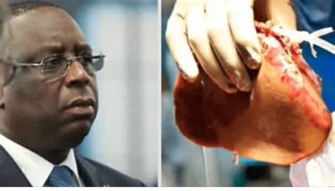 Transplantation rénale au Sénégal Macky salue une première AGORA INFO