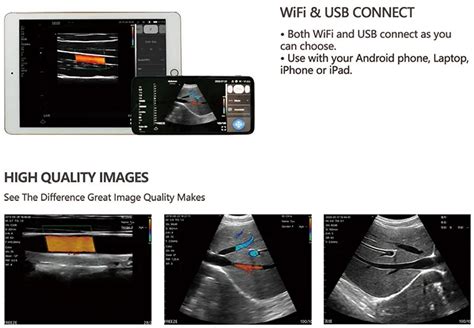 Handheld Ecografo Portatil Convex Linear 2 In 1 Wireless Ultrasound