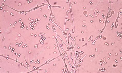 Branching Budding Yeast Cells With Pseudohyphae In Urine Fine W Stock