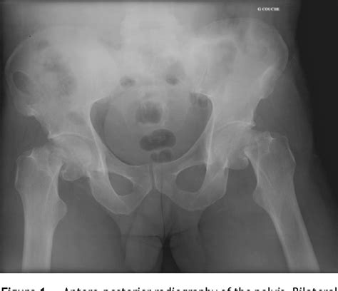 Figure From Simultaneous Bilateral Femoral Neck Fractures Secondary