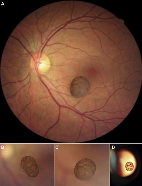 Iris Cysts A Comprehensive Review On Diagnosis And Treatment Survey