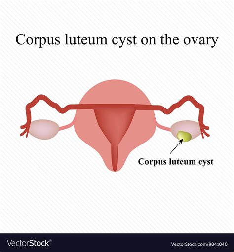 Functional Ovarian Cysts Hot Sex Picture